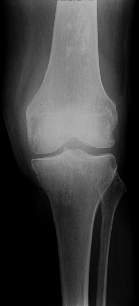 Bone Tumours And Benign Lytic Lesions